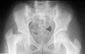 An X-ray of the hips showing a normal left side and coxa vara on the right side.